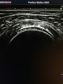 Echographie