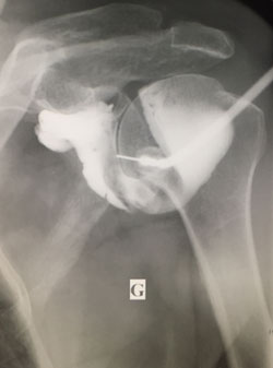 Arthrographie 2