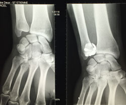 Arthrographie